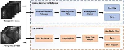 Automated Quantitative Analysis of Blood Flow in Extracranial–Intracranial Arterial Bypass Based on Indocyanine Green Angiography